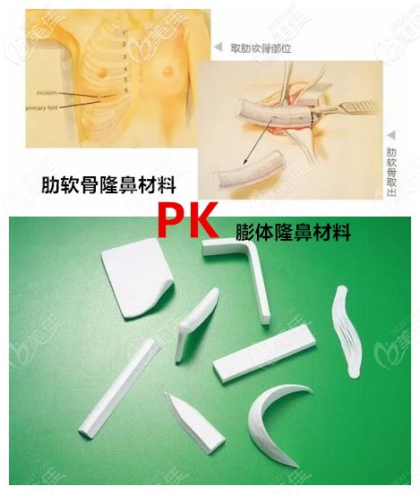 肋软骨隆鼻和膨体隆鼻的对比