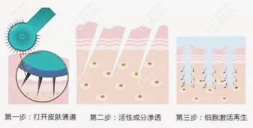 微针去颈纹的治疗过程 微针去颈纹的治疗过程