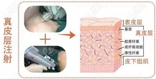 嗨体注射去颈纹过程 嗨体注射去颈纹过程