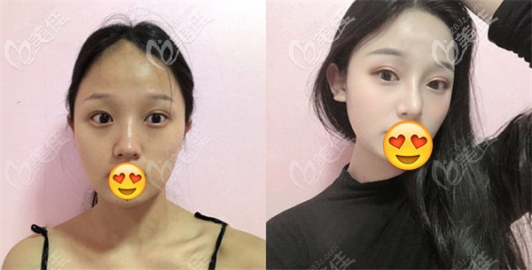 找雷医生做鼻综合的手术效果