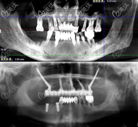 王明院长拿手的穿颧种植牙手术