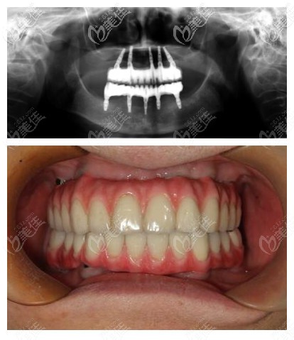 杭州美奥口腔关院经典的全口即刻负重种植图