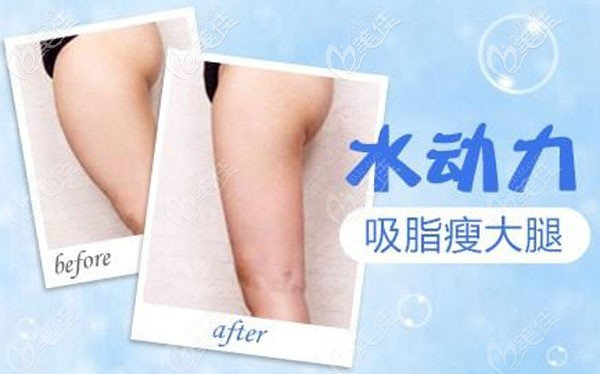 德国水动力吸脂效果怎么样