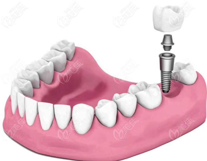 种植牙为什么这么贵