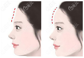 假体丰额头效果图参考 假体丰额头效果图参考