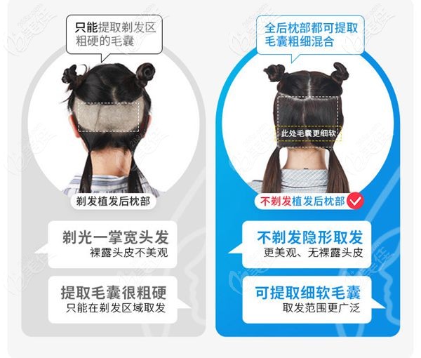 成都首瑞不剃发植发技术 成都首瑞不剃发植发技术