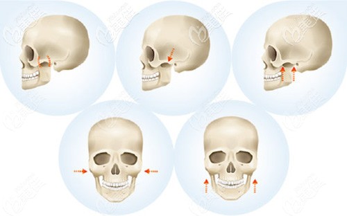 何院长做颧骨整形的手术原理 何院长做颧骨整形的手术原理