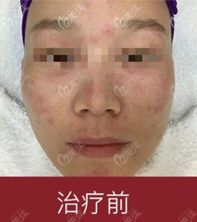 激光祛斑前 激光祛斑前
