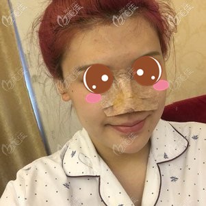 在福州格莱美做鼻修复术后2天