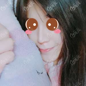 在福州格莱美做鼻修复术后7天