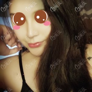 在福州格莱美做鼻修复术后1个月