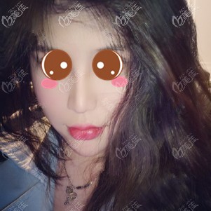 在福州格莱美做鼻修复术后2个月