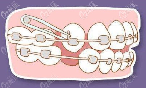 牙齿矫正中需要打骨钉