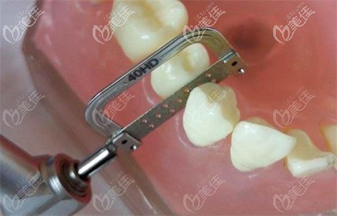 正畸矫正中需要磨牙或者拔牙