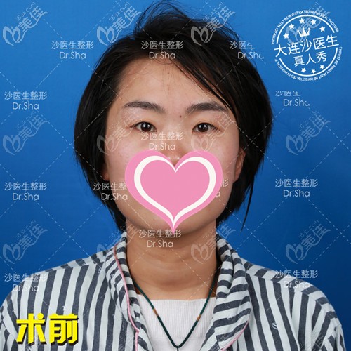 大连沙医生双眼皮案例