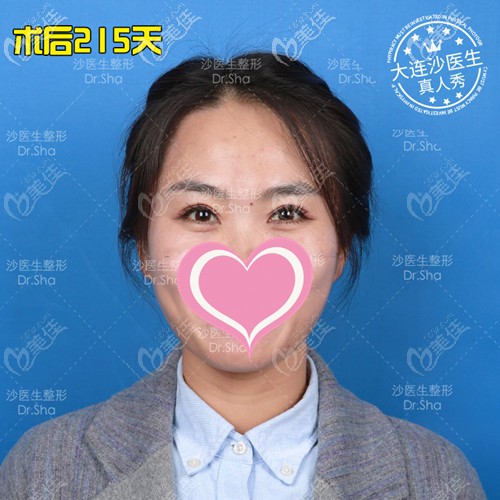 大连沙医生双眼皮案例