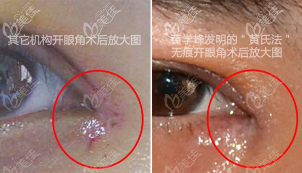 惠州诗璐医疗美容黄学峰医生内眼角修复技术优势对比