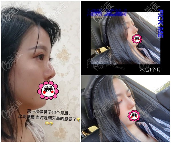 张龙鼻修复案例