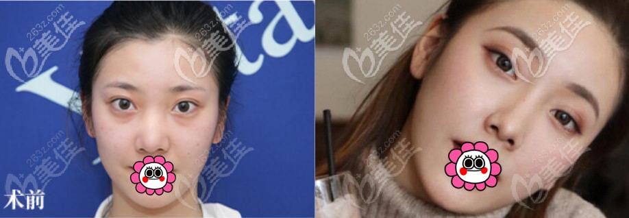 徐利刚隆鼻案例