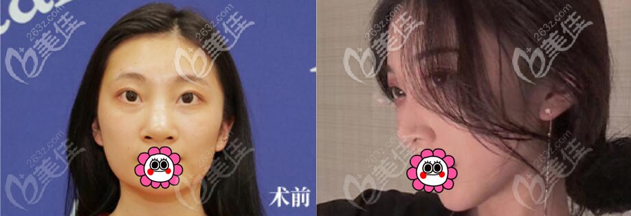 付德刚隆鼻案例