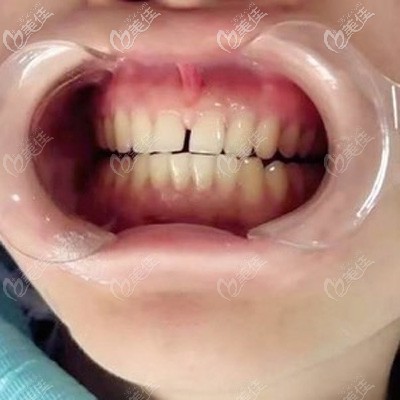 全瓷贴面改善牙缝大牙黄手术中
