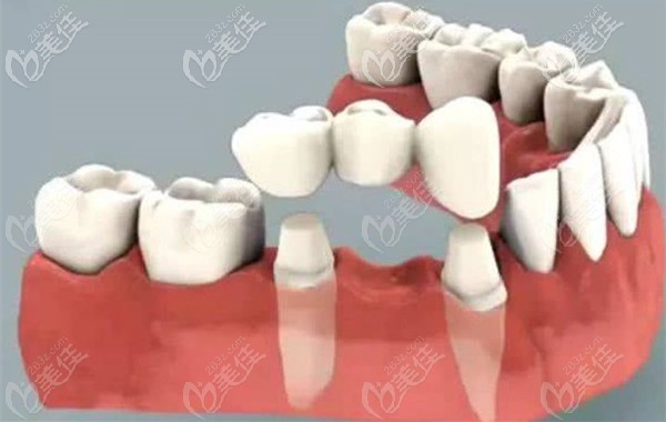 瓷贴面手术的原理