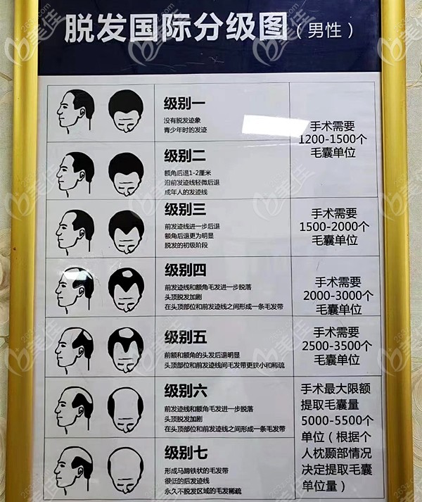 男性4级脱发m型发际线后退4厘米植发需要种植多少株毛囊
