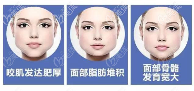 咬肌和脂肪堆积的下颌角肥大