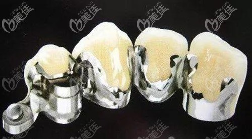 钛合金烤瓷牙