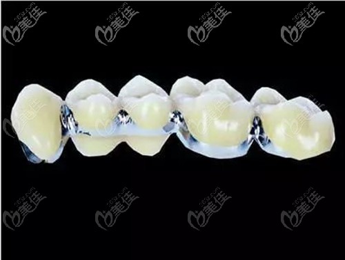 钴铬内冠烤瓷牙