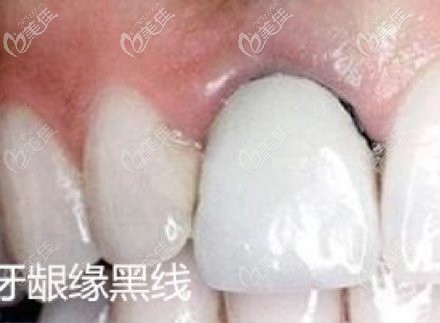 镍铬合金烤瓷牙导致牙龈黑线