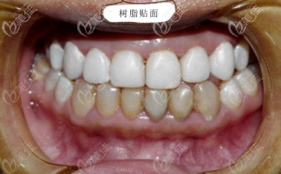 树脂贴面修复效果图 树脂贴面修复效果图