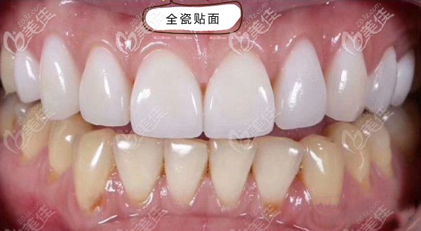 全瓷贴面修复效果图 全瓷贴面修复效果图