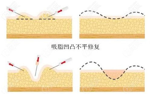大腿吸脂失败修复办法