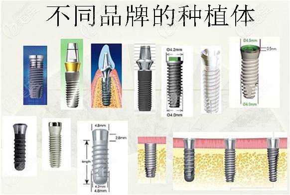 不同品牌种植体包括韩国植体系列 不同品牌种植体包括韩国植体系列
