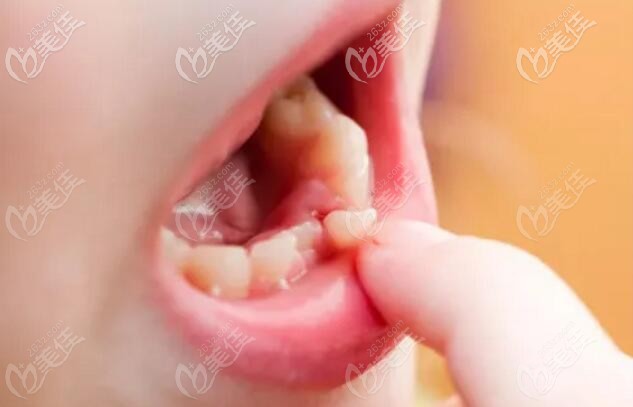 乳牙和恒牙更换期