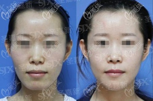 北京圣嘉新张笑天颧骨整形对比图