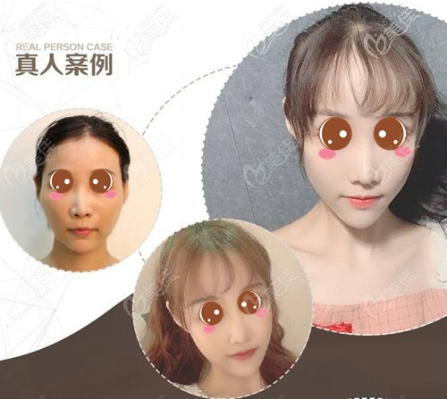 北京艺美王东不开刀降颧骨对比图