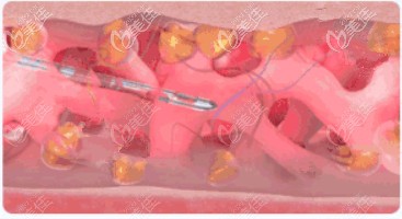 张悦迪医生做面部抽脂不损伤血管网