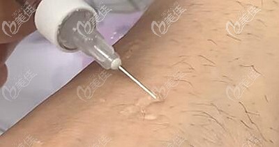 铂金瑞蓝玻尿酸的柔软程度 铂金瑞蓝玻尿酸的柔软程度