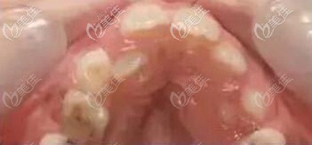 不戴牙齿间隙保持器的后果