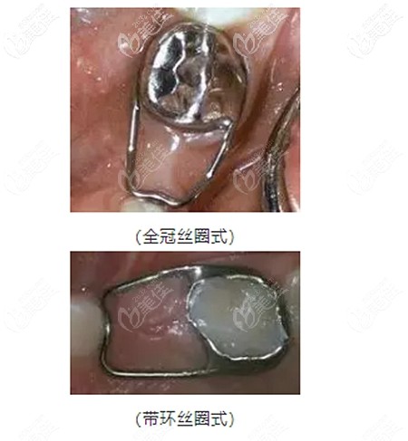 牙齿间隙保持器的不同类型