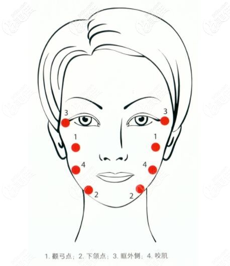 锯齿线的进针位置