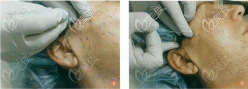 锯齿线一般埋到筋膜层