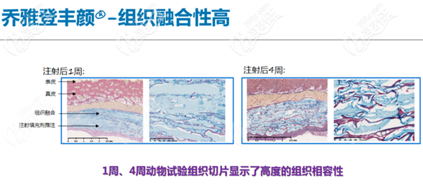 乔雅登丰颜注射后效果自然