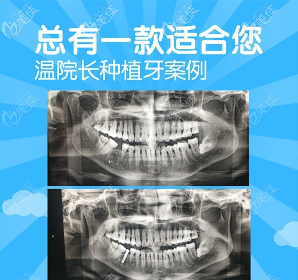 秦皇岛蓝天种植牙价格表 秦皇岛蓝天种植牙价格表