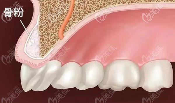 你知道哪些情况是需要植骨