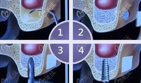 骨头量太少，种植体长不稳