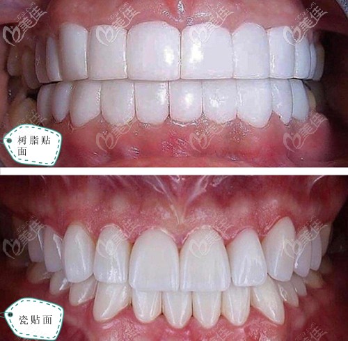 树脂贴面和瓷贴面效果对比图 树脂贴面和瓷贴面效果对比图