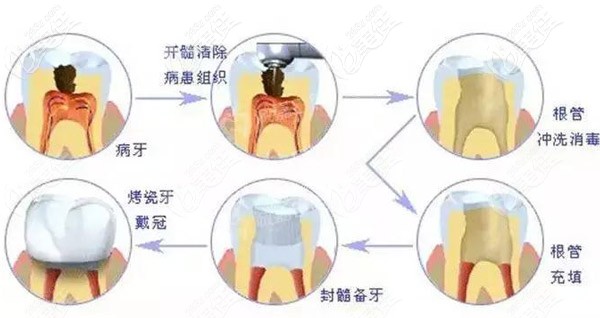 根管治疗后坚决不做牙冠会导致什么？
